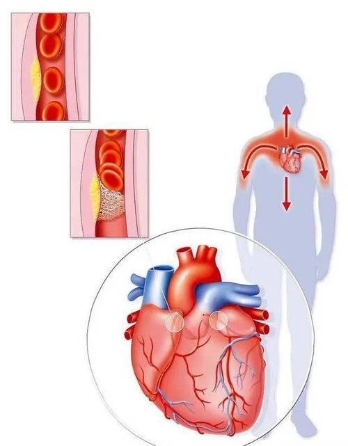 心脏病所致的血管斑块导致的血管狭窄更是影响人类生命健康的罪魁祸首