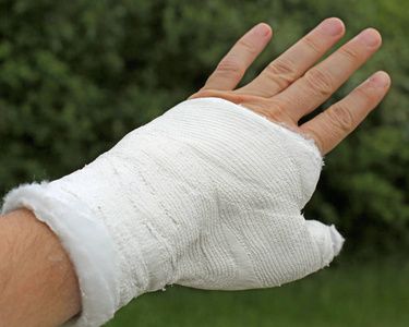 拇指方阵骨折后用白色医用石膏伤手照片