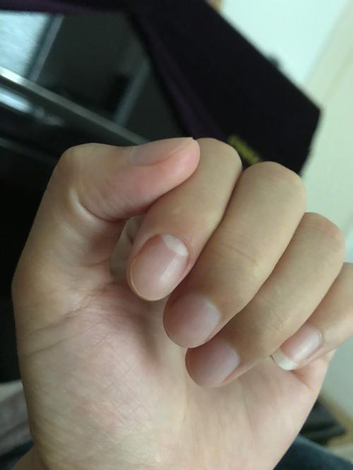 就食指这样,别的手指都好好的食指甲膜脱落了,边缘红肿8.