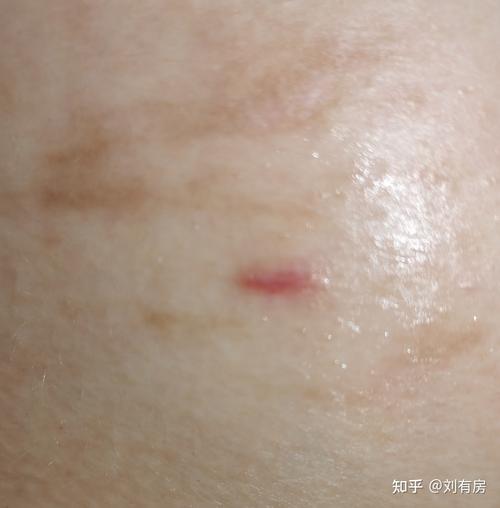 广州中山二院乳腺纤维瘤微创记录