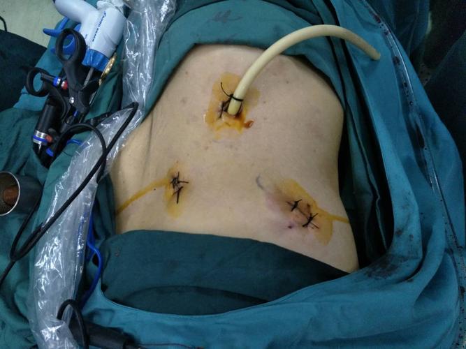 榆林市第一医院泌尿外科再次实现技术突破:后腹腔镜镜下右肾肿瘤部分