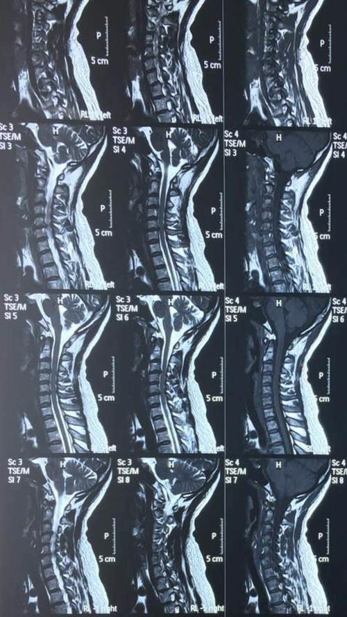 脊柱解剖与手法实战课程———颈椎实战篇