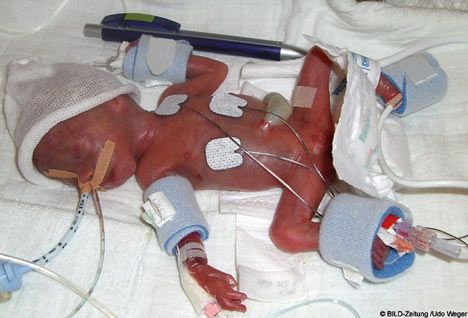 世上最小早产儿出院 诞生时跟手机一样大