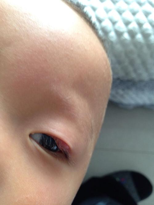 14个月的婴儿眼皮上长了个囊中怎么治疗碍事吗?谢谢!