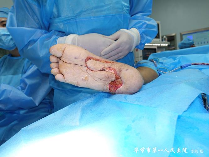毕节市第一人民医院烧伤整形外科完成足底内侧皮瓣修复足跟部软组织
