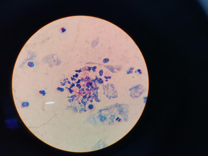 弱抗酸染色     弱抗酸阳性是如卡菌重要的生物学特征,染色成功的关键