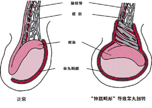 鞘膜内型,是睾丸扭转的主要类型.