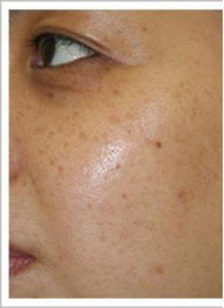皮肤油脂分泌不均衡,没有及时清理导致毛孔堵塞,皮肤垃圾无法排出