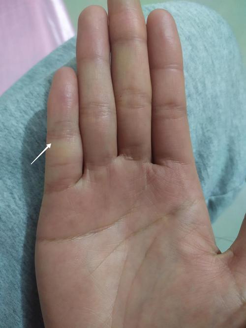 正常人的小手指关节都有两条线分成三节