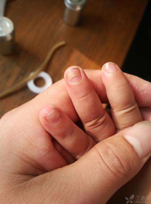 2岁女孩,手指甲分层脱落,脱落后的指甲菲薄,以指甲尖部脱落为主!