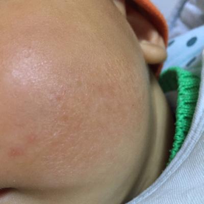 宝宝脸上湿疹好了之后皮肤变亮亮的,像塑料薄膜一样,请问这是怎麼回事