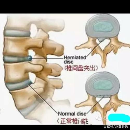 单杠悬垂在治疗腰椎间盘突出中的效果
