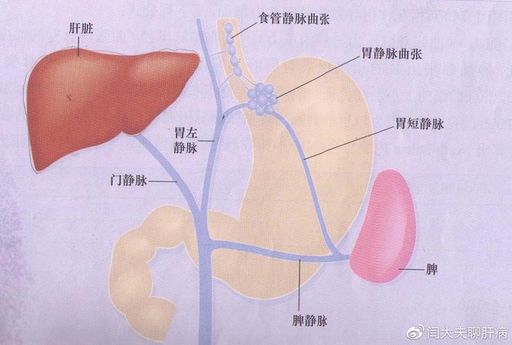 食道胃底静脉曲张就是图中的那一堆串珠样堆积在食道和胃底部位的迂曲