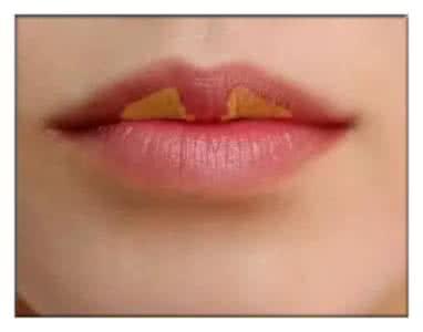 一般而言,唇珠就是上唇中间明显有好似一粒珠子似的突出而下垂的肉,此