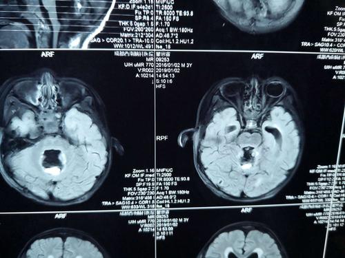 儿童四脑室巨大肿瘤病例分享