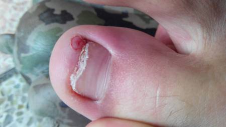 我的大脚趾头的指甲长到肉里去了!非常痛!