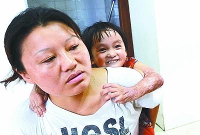 图为郑女士与4岁的养女琳琳,小女孩因为烫伤手已经严重变形.