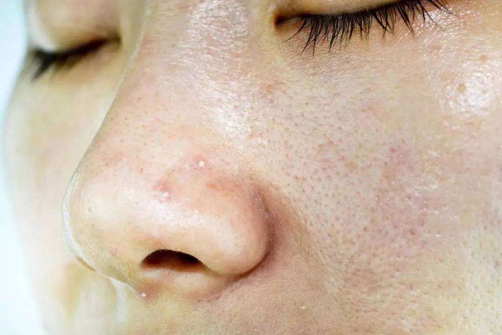 长春肤康医院浅谈油性皮肤为什么更容易长粉刺用哪些药物可以治疗