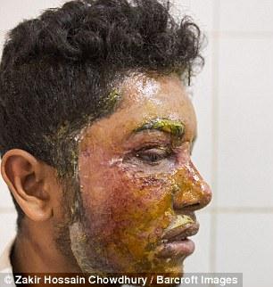 孟加拉国一16岁女孩求爱不成 向男孩脸上猛泼硫酸致其重度毁容