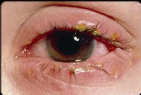 当眼睛分泌出的黄绿色液体,此时最有可能是被细菌感染引起的红眼病.