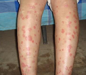 结节性红斑是一种比较常见的 血管炎皮肤疾病,在临床上多发病于中