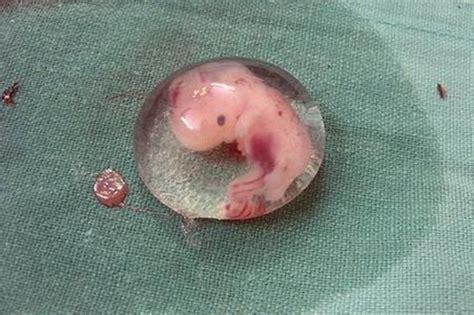 孕囊是原始的胎盘组织,被羊膜,血管网包裹的小胚胎,灰白色毛绒状.