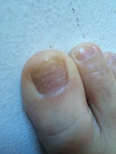 脚上大拇指指甲 凹凸不平 里面有白色的横痕 指甲尖偏黄 感觉也不是灰
