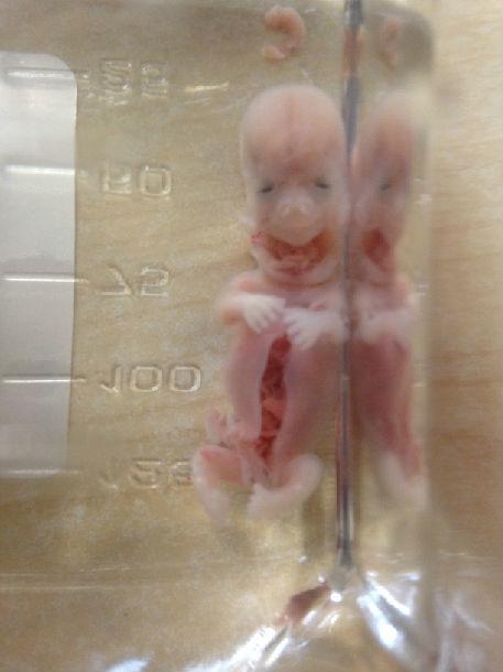 看看下面的图片,您难道愿意这样的胎儿没有发生自然流产吗?