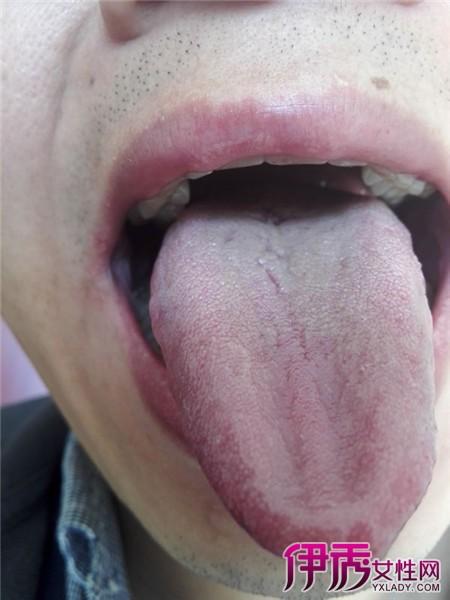 【图】舌根淋巴滤泡增生的临床表现有哪些 4大症状引起病发