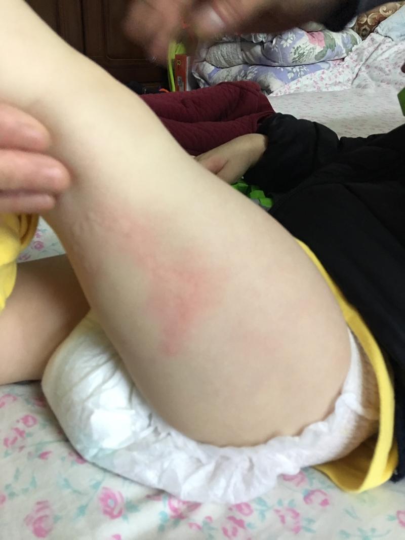 一岁半男宝宝突然发现腿上发出来一大块红斑,凸起,是不是对什么东西