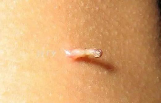 患者的皮肤会出现细长柔软的疣状赘生物,一般有人乳头瘤病毒感染所