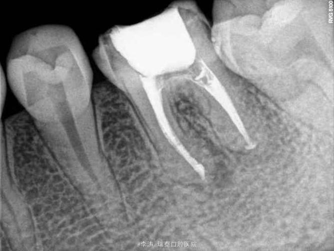 后牙慢性根尖周炎一次性根管治疗一例