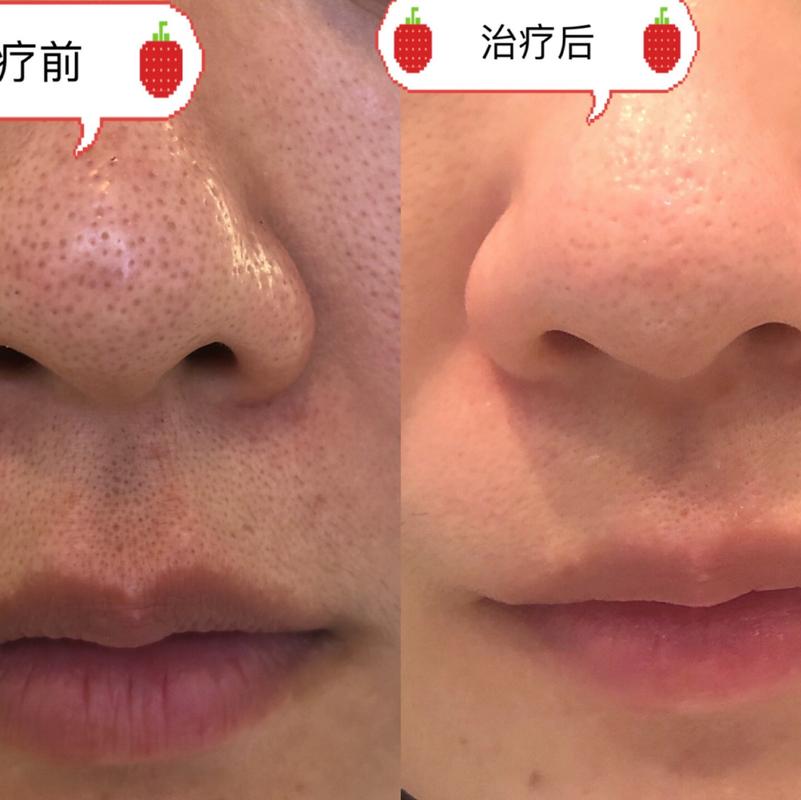 草莓鼻终于有救啦来日本必体验医美项目