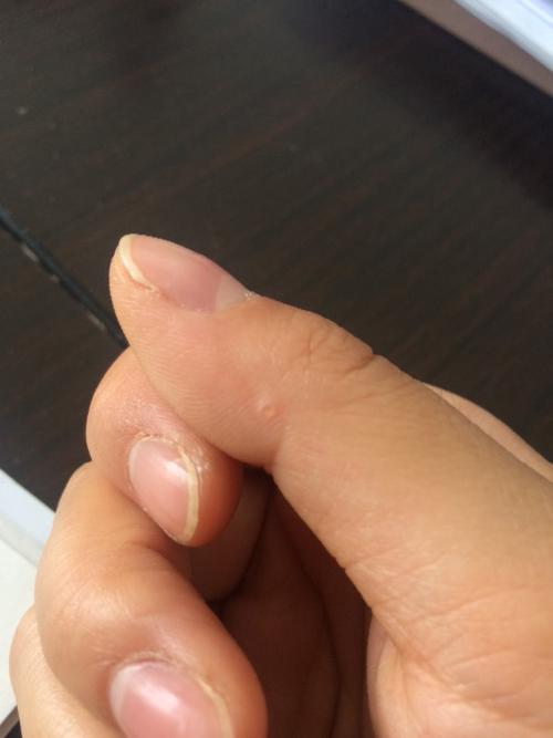右手大拇指关节外侧长了粒透明小颗粒,硬硬的,戳下去会硌的疼,用指