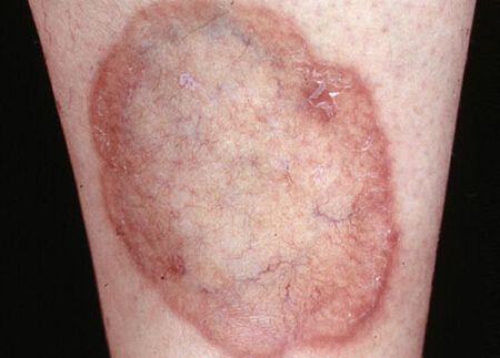 皮肤科 结节性红斑 疾病百科 结节性红斑(erythema nodosum)是发生于