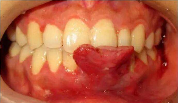 哪些疾病会引发牙龈出血