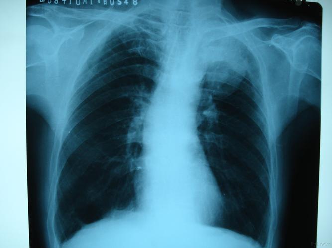 能诊断为左肺肺上沟癌吗