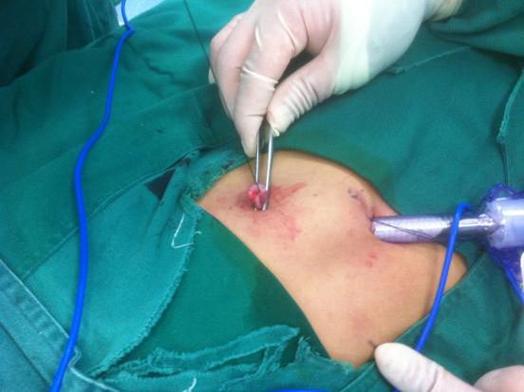 微创腹腔镜两孔法阑尾切除