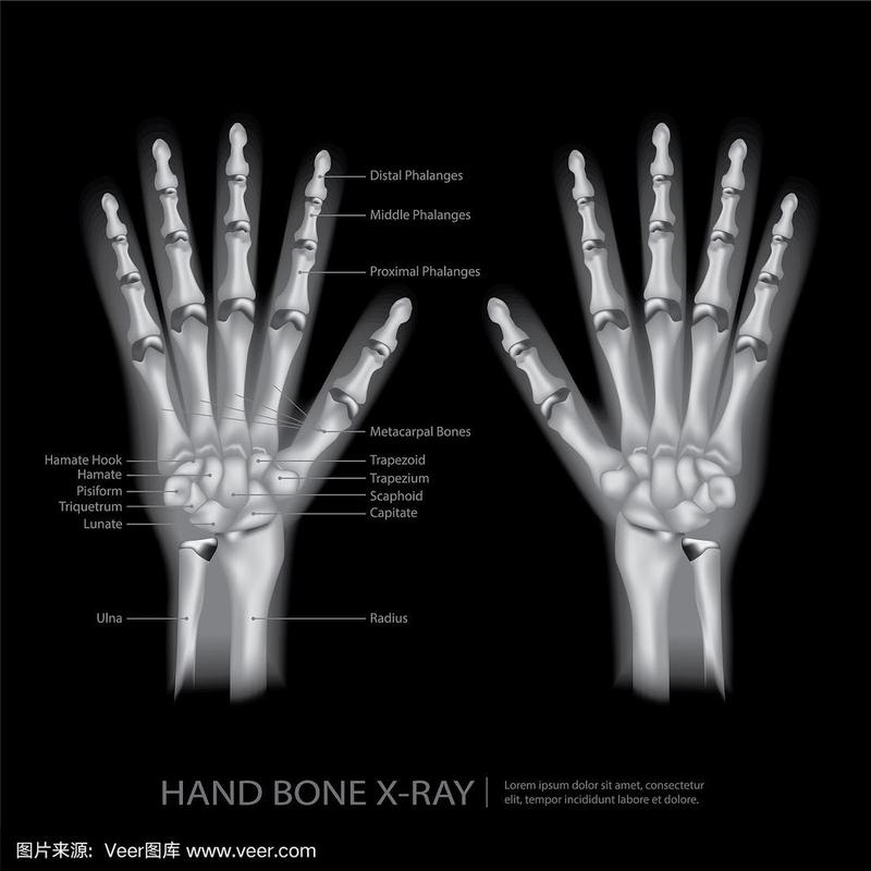 手骨x射线