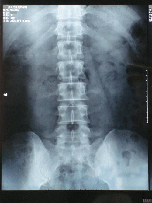 求助此患者是椎间盘突出症还是腰椎后关节损伤请教如何治疗