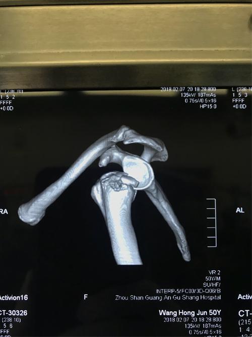 关节镜下滑车式缝线桥治疗肱骨大结节撕脱性粉碎性骨折