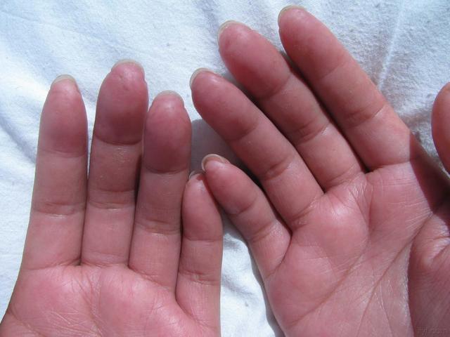 全身硬化症又称硬皮症患者皮肤会变硬晚期可导致手指钙化