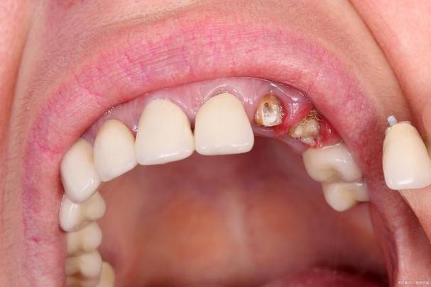 而很多人对于缺牙并不重视,即使牙齿掉了,也没有及时去补牙,放任这种