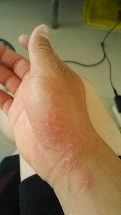 手发痒有水泡.四年病史.天气越热病况越严重.