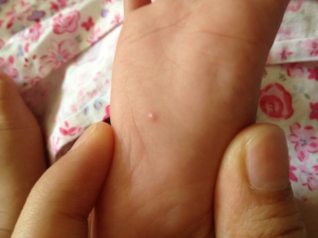 宝宝手上,双脚一共长了3粒这个红点,没发热厌食,请问这是手足口病吗?