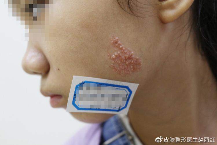 广东燕岭医院:皮脂腺痣有哪些危害?