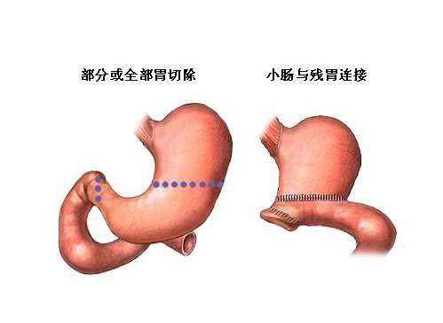 胃切除术手术图解