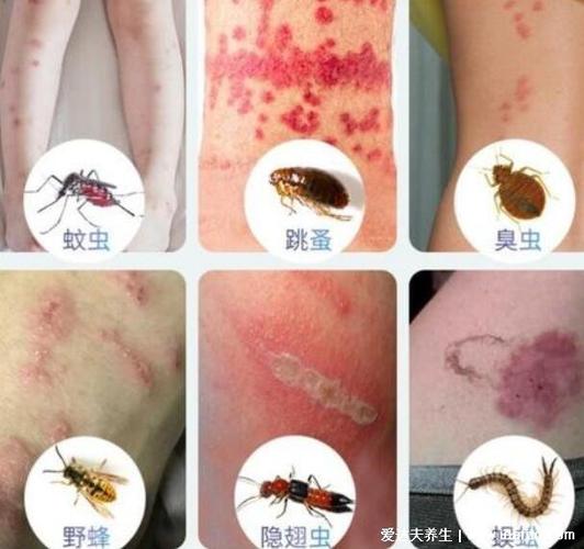 丘疹性荨麻疹图片,各种昆虫叮咬形成的虫咬性皮炎(附症状)