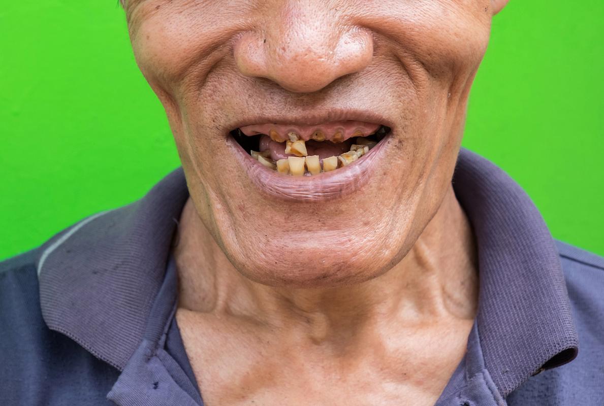 种植牙齿# #种牙# 当老年人面临牙齿脱落的问题时,他们往往会感到