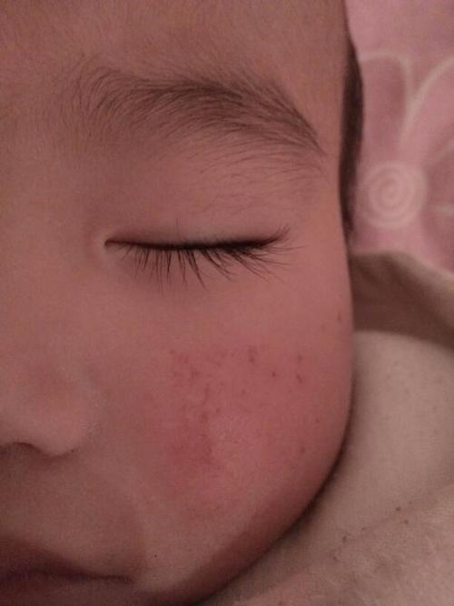 一岁宝宝脸上突然发红 第二天红疹自己破了 什么原因 该用什么药 都有